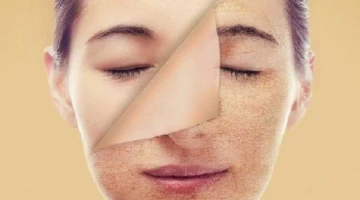 أسباب تصبغات الجلد البنية