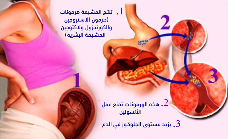 bilobed placenta gestational diabetes